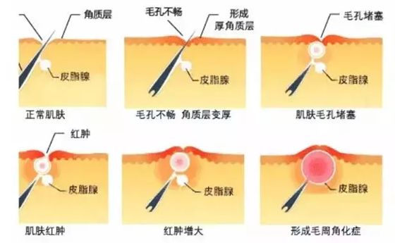 人為什么會(huì)起雞皮疙瘩